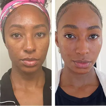 Before and after result 4