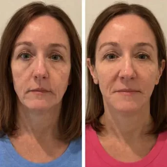 Before and after result 3